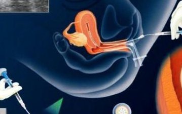 做试管婴儿需要满足什么条件？价格多少？