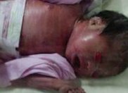 双侧输卵管阻塞患者试管用什么方案？怀孕准备方法和解决方案是什么？