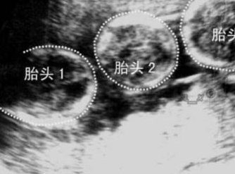 2026年幼稚子宫可以在怀化市妇幼做三代试管吗？大概要花费多少钱？